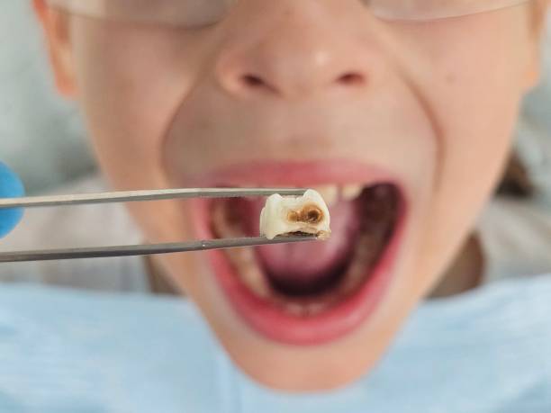 Best Cracked Tooth Emergency Dentist  in San Anselmo, CA